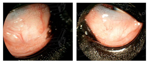 tratamiento-conjuntivitis-folicular
